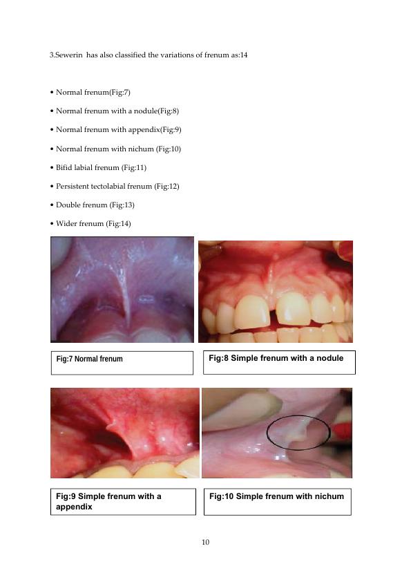 Frenum Attachment and its applied Ascpect. Anatomy, Syndromes ...